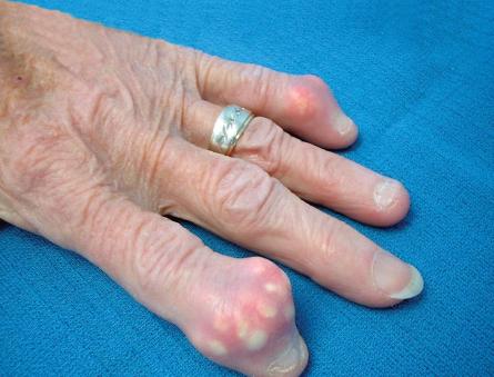 Шишки на фалангах пальцев рук – незначительный дефект или тревожный сигнал?